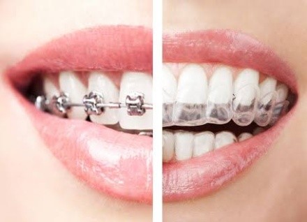 dental braces price in Nigeria