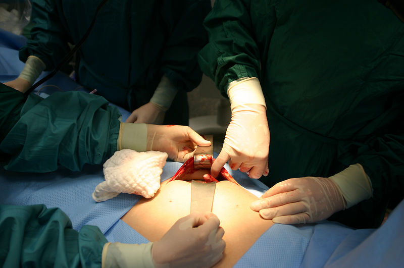 cost of appendix surgery in Nigeria