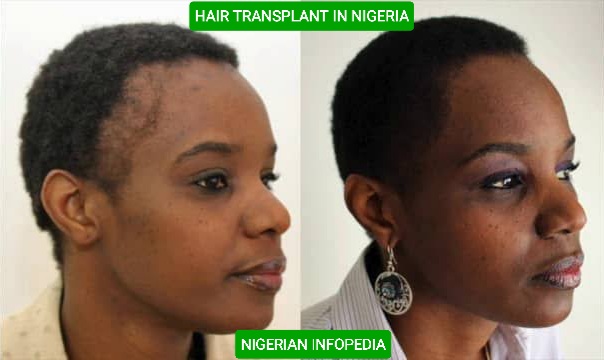 hair transplant in Nigeria